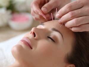 Close-up of a woman with acupuncture needles placed on her forehead during a spa treatment.